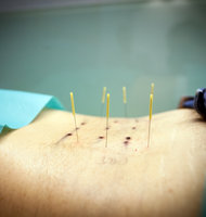 Acupuncture Article from New York Times on Jeannie Ng Acupuncturist www.JeannieNg.com